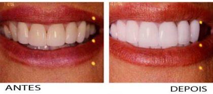 clareamento dental caseiro Antes e depois