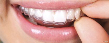 clareamento dental caseiro opções